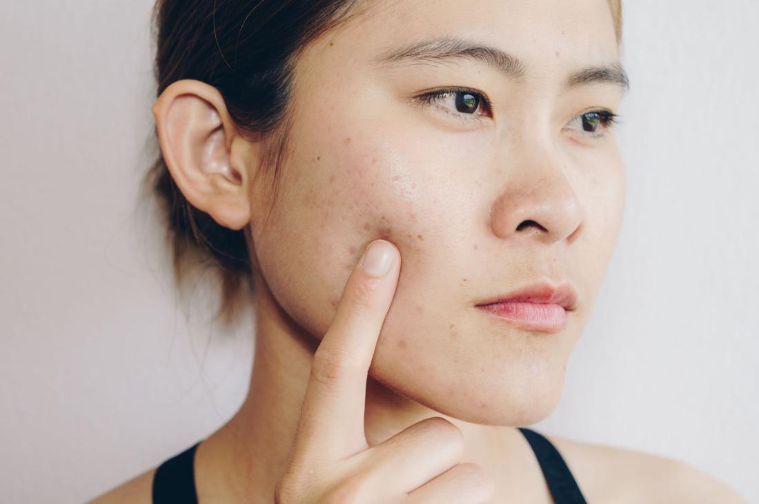 Unlocking Acne Mysteries: Types, Causes, and How BMF Facials Can Save the Day!