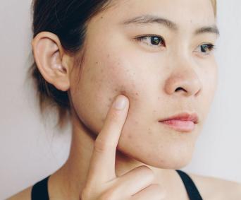 Unlocking Acne Mysteries: Types, Causes, and How BMF Facials Can Save the Day!