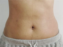 Before & After: Abdomen