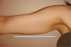Before & After: Arm