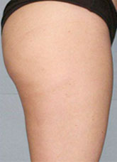 Before & After: Thigh