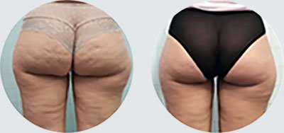 Cellulite and localised fat