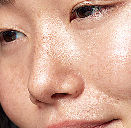 Age Spots and Hyperpigmentation