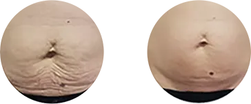 Localised fat and laxity