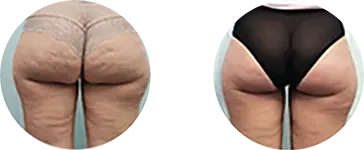 Cellulite and localised fat