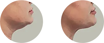 Localised fat (submental)